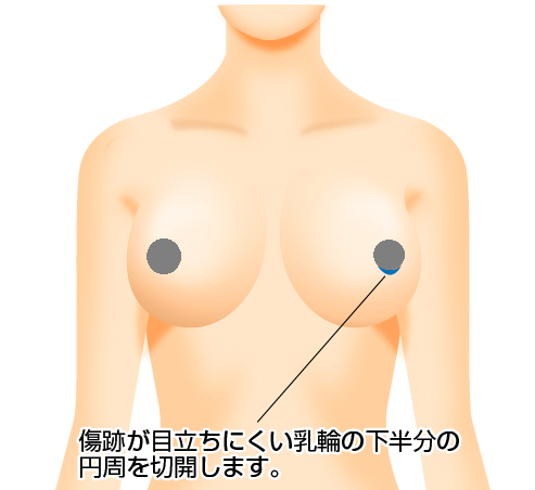乳房切除法