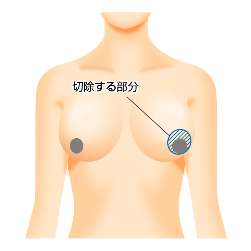 切除する部分