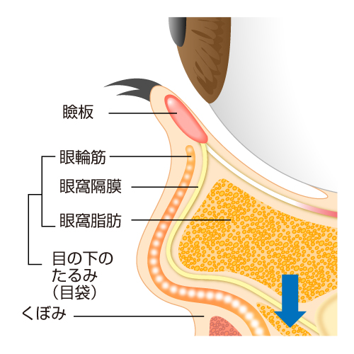 目の下のたるみの原因