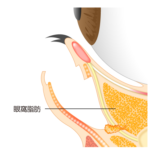 下まつげのすぐ下を切開し、たるみの原因となっている眼窩脂肪を切除します
