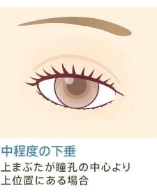 中程度の下垂 上まぶたが瞳孔の中心より上位置にある場合