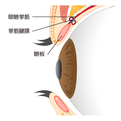 「腱膜縫縮法」