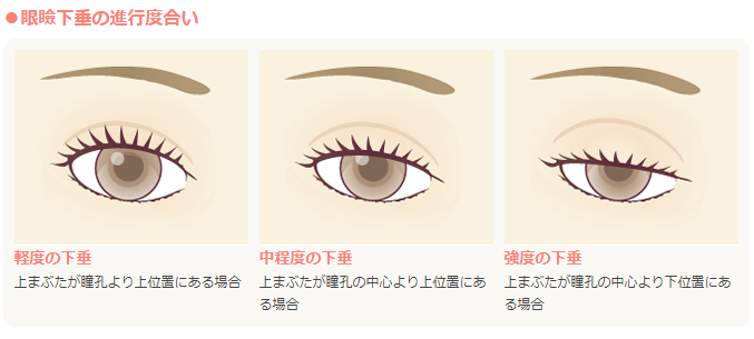 眼瞼下垂の進行度合い 軽度の下垂 上まぶたが瞳孔より上位置にある場合 中程度の下垂 上まぶたが瞳孔の中心より上位置にある場合 強度の下垂 上まぶたが瞳孔の中心より下位置にある場合