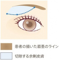 切開範囲図