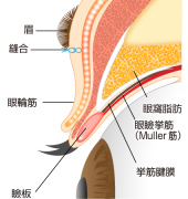 余剰皮膚を切除し縫合