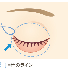 骨のライン