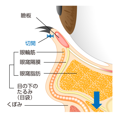 切除位置　眼窩隔膜と脂肪を移動