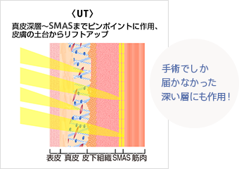 ドクターハイフ（UT）