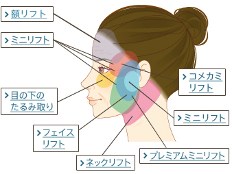 額リフト ミニリフト 目の下のたるみ取り フェイスリフト ネックリフト コメカミリフト ミニリフト プレミアムミニリフト