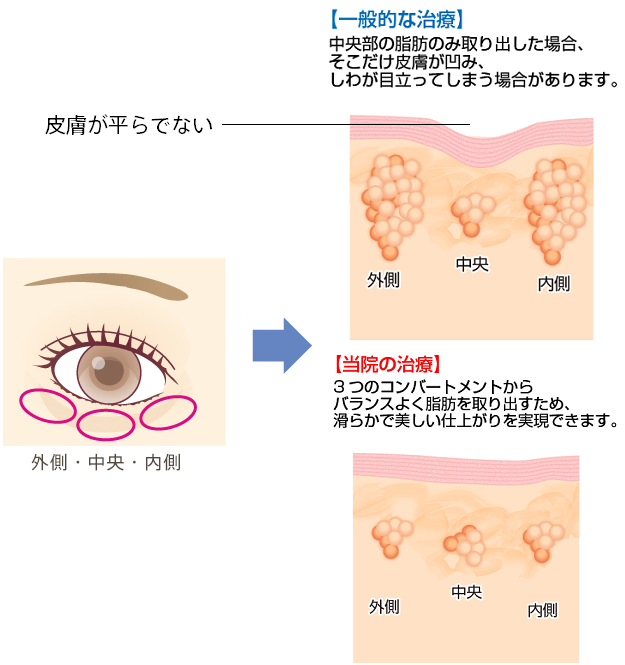 【一般的な治療】中央部の脂肪のみ取り出した場合、そこだけ皮膚が凹み、しわが目立ってしまう場合があります。 【当院の治療】3つのコンバートメントからバランスよく脂肪を取り出すため、滑らかで美しい仕上がりを実現できます。