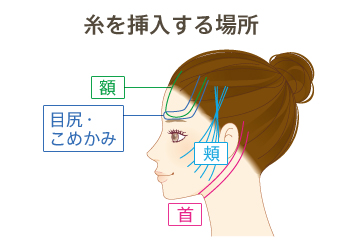 糸を挿入する場所 額 目尻・こめかみ 頬 首