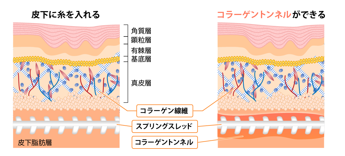 皮下に糸を入れる コラーゲントンネルができる