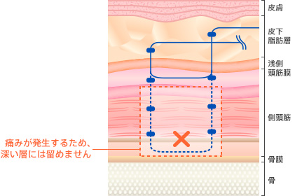 痛みが発生するため、深い層には留めません