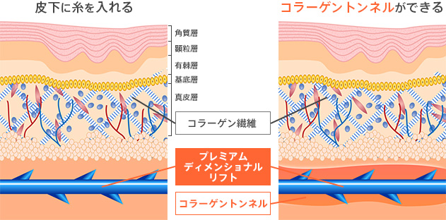 皮下に糸を入れる コラーゲントンネルができる