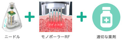 ニードル＋モノポーラーRF＋適切な薬剤