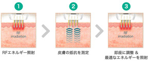 1.RFエネルギー照射 2.皮膚の抵抗を測定 3.即座に調整＆最適なエネルギーを照射