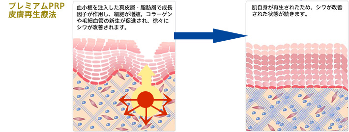 プレミアムPRP皮膚再生療法 血小板を注入した真皮層・脂肪層で成長因子が作用し、細胞が増殖。コラーゲンや毛細血管の新生が促進され、徐々にシワが改善されます。 → 肌自身が再生されたため、シワが改善された状態が続きます。