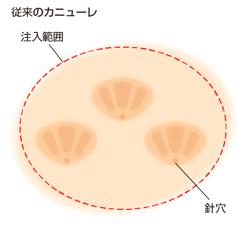 注入できる範囲が狭く、何ヵ所も注入するため、ムラになりやすい。また、針穴も多く、目立ってしまう。