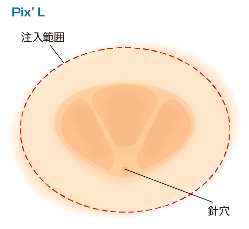 一度に広範囲に注入できるため、ムラになりにくい。また、広範囲に注入できるため、針穴が少なくてすむ。