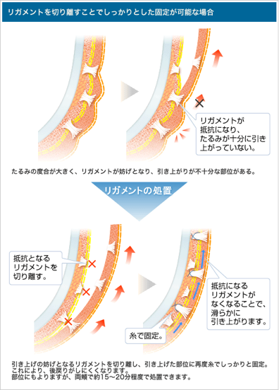 リガメントを切り離すことでしっかりとした固定が可能な場合：リガメントが抵抗になり、たるみが十分に引きあがっていない。たるみの度合いが大きく、リガメントが妨げとなり、引きあがりが不十分な部位がある。→リガメントの処置→抵抗となるリガメントを切り離す。糸で固定。抵抗になるリガメントがなくなることで、滑らかに引きあがります。引き上げの妨げとなるリガメントを切り離し、引き上げた部位に再度糸でしっかりと固定。これにより、後戻りがしにくくなります。部位にもよりますが、両頬で約15～20分程度で処置できます。