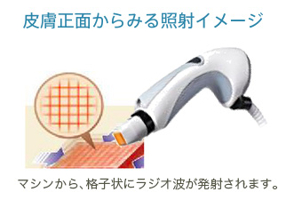 皮膚正面からみる照射イメージ　マシンから、格子状にラジオ波が発射されます。