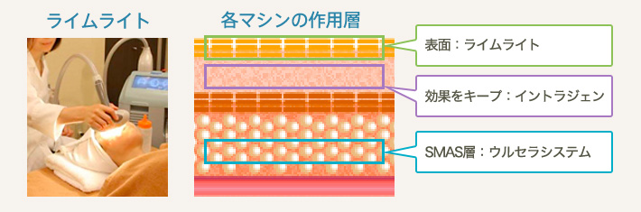 ウルセラシステム+イントラジェン+ライムライト