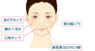 目の下のシワ、頬のくぼみ、口角のシワ、唇の縦ジワ、鼻唇溝（ほうれい線）