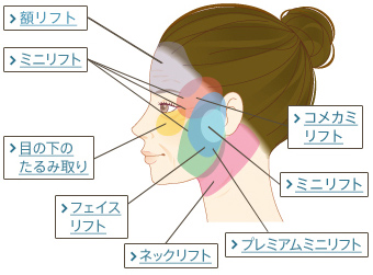 額リフト、ミニリフト、コメカミリフト、目の下のたるみ取り、フェイスリフト、ミニリフト、ネックリフト、プレミアムミニリフト