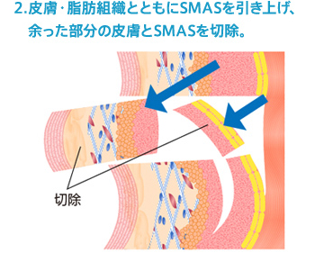 2.皮膚・脂肪組織とともにSMASを引き上げ、余った部分の皮膚とSMASを切除。