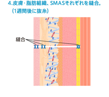 4.皮膚・脂肪組織、SMASそれぞれを縫合。（1週間後に抜糸）
