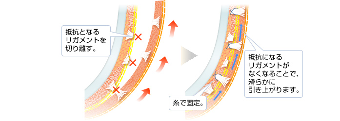 抵抗となるリガメントを切り離す。糸で固定。抵抗になるリガメントがなくなることで、滑らかに引き上がります。