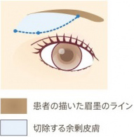 患者の書いた眉墨のライン・切除する余剰皮膚