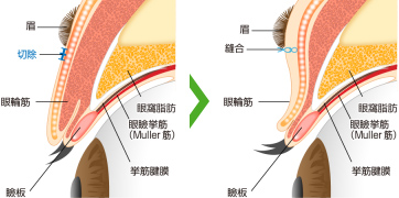 余剰皮膚を切除し縫合