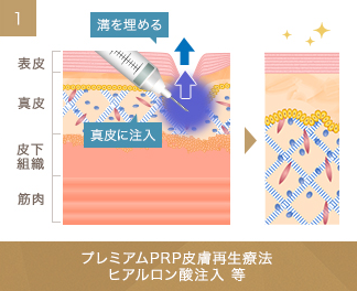 プレミアムPRP皮膚再生療法,ヒアルロン酸注入等　真皮に注入　溝を埋める