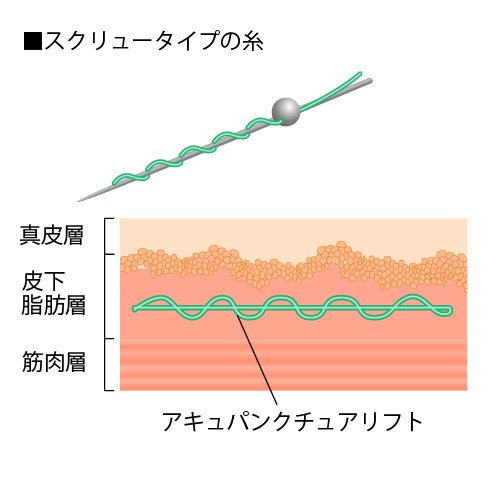スクリュータイプの糸の挿入イメージ