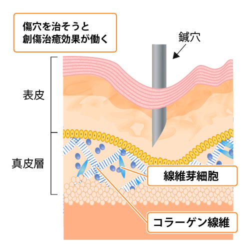 傷穴を治そうと創傷治癒効果が働く