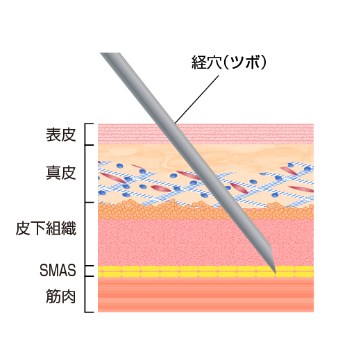 鍼（針）刺激による筋肉の緊張・弛緩バランス調整