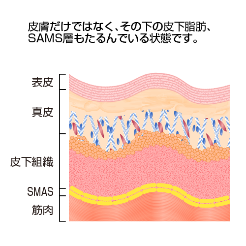 皮膚だけではなく、その下の皮下脂肪、SMAS層もたるんでいる状態です。