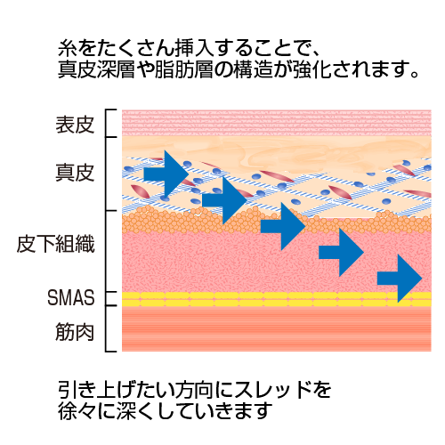 糸をたくさん挿入することで、真皮深層や脂肪層の構造が強化されます。引き上げたい芳香にスレッドを徐々に深くしていきます。