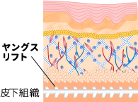 ①皮下組織にYOUNGSリフト（ヤングスリフト）を挿入