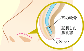 鼻の内側を切開し、鼻孔縁にポケットを作成します。ここに採取した軟骨を移植することで、鼻の穴の皮膚が下方へ押し下げられます。