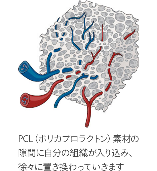 PCL（ポリカプロラクトン）素材の隙間に自分の組織が入り込み、徐々に置き換わっていきます