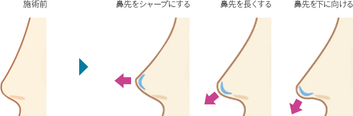 施術前　鼻先をシャープにする　鼻先を長くする　鼻先を下に向ける