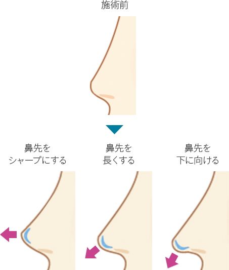 施術前　鼻先をシャープにする　鼻先を長くする　鼻先を下に向ける