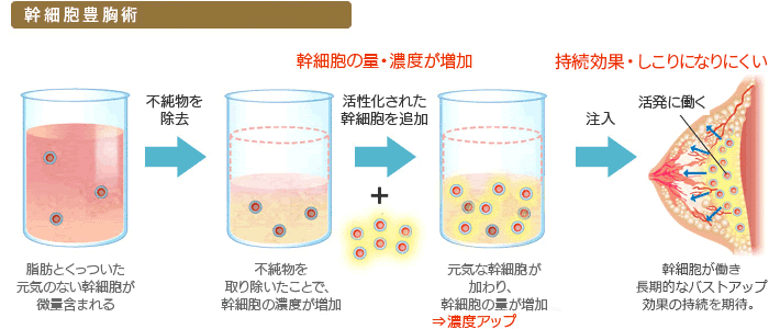 幹細胞豊胸術 脂肪とくっついた元気のない幹細胞が微量含まれる 不純物を除去 幹細胞の量・濃度が増加 不純物を取り除いたことで、幹細胞の濃度が増加 活性化された幹細胞を追加 元気な幹細胞が加わり、幹細胞の量が増加⇒濃度アップ 注入 持続効果・しこりになりにくい 幹細胞が働き長期的なバストアップ効果の持続を期待。