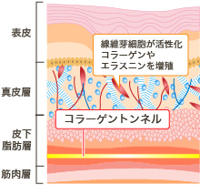 線維芽細胞が活性化。コラーゲンやエラスチンを増殖。 コラーゲントンネル