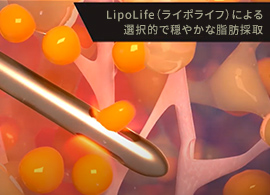 LipoLife（ライポライフ）による選択的で穏やかな脂肪採取