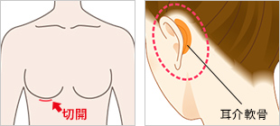 肋軟骨/耳介軟骨の採取