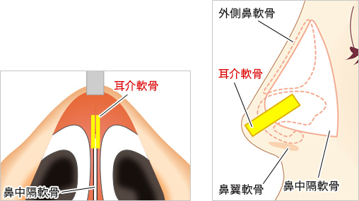 ③肋軟骨/耳介軟骨（もしくは両方の軟骨）で支柱を立てる