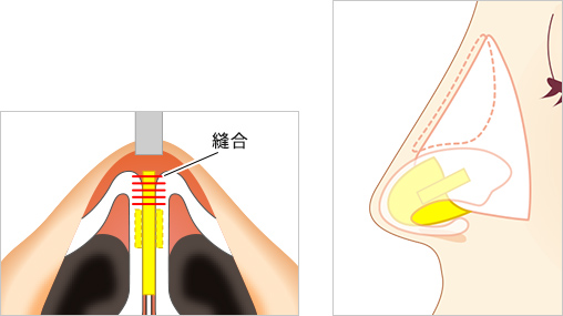 ④鼻翼軟骨を閉じる